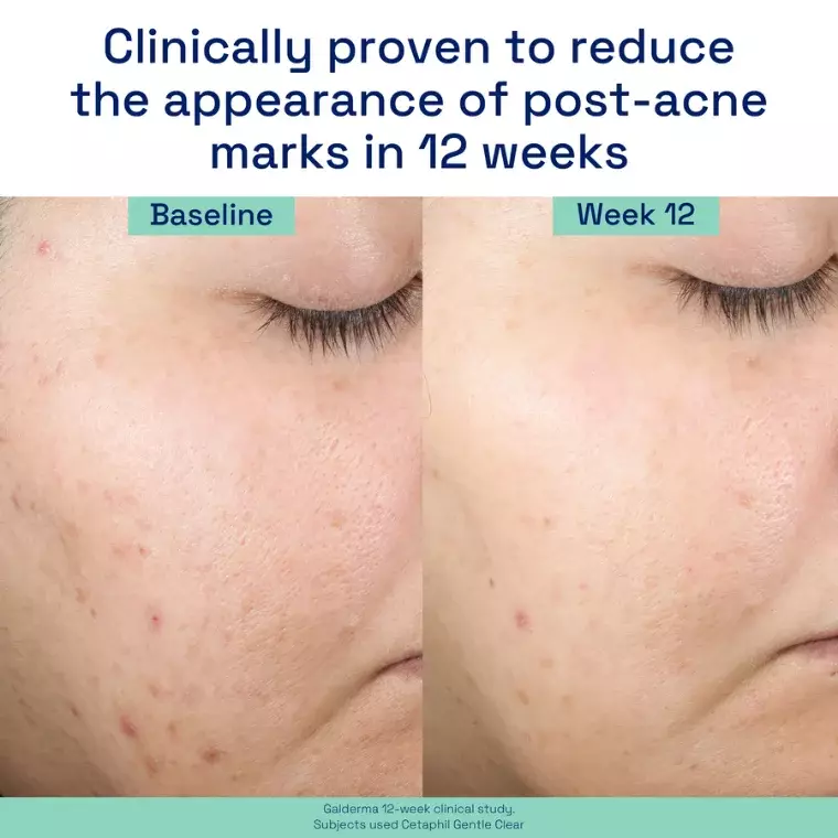 Cetaphil Acne Gentle Clear Repairing Post Acne Serum (30ml)